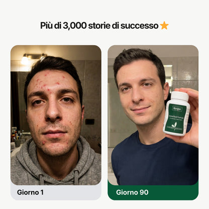 Acne Root Formula®
