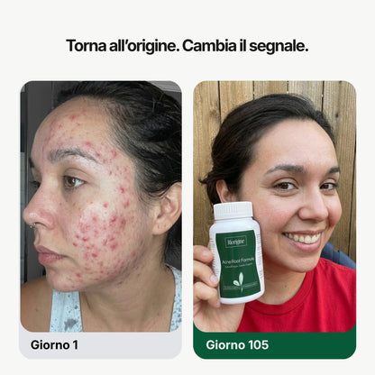 Acne Root Formula®
