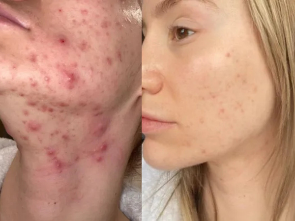 Before After