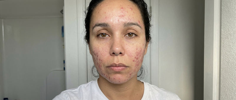 Acne adulta · ritratto